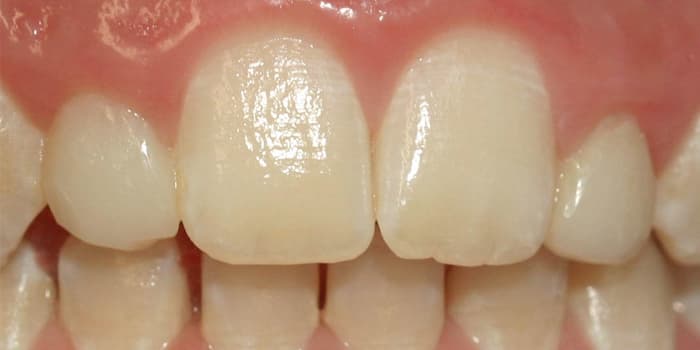 Adhäsivtechnik nachher