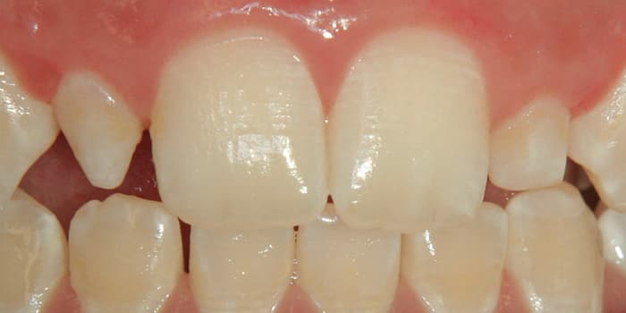 Adhäsivtechnik vorher