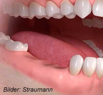 Implantatgetragene Brücke 1