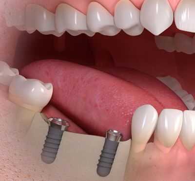 Implantatgetragene Brücke 2