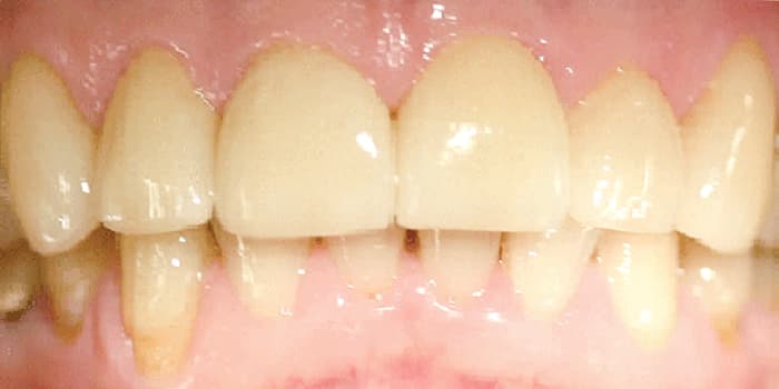 Teilkeramikkronen mittels Emax-Technik - nachher