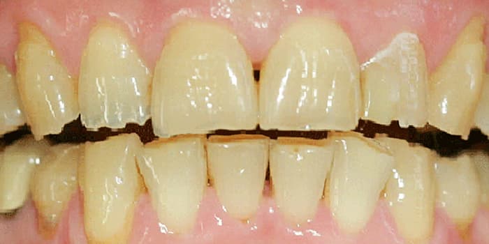 Teilkeramikkronen mittels Emax-Technik - vorher