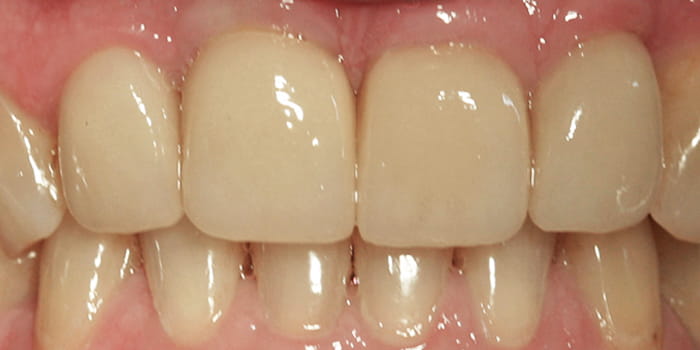 Vollkeramikkronen mittels Emax-Technik - nachher