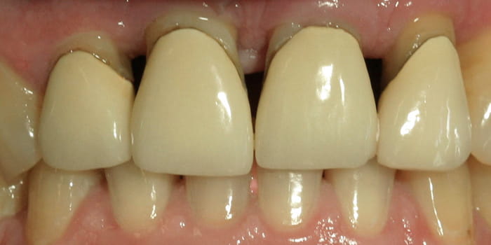 Vollkeramikkronen mittels Emax-Technik - vorher