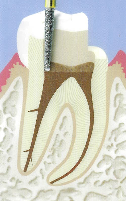 Endodontie-3
