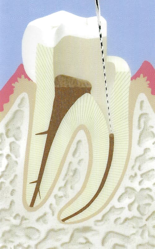 Endodontie-4