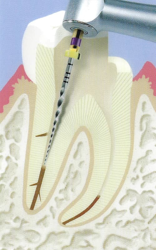 Endodontie-5