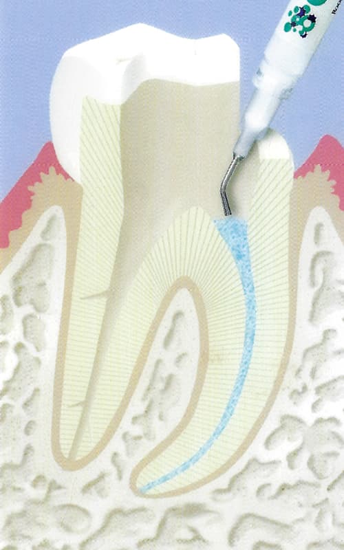 Endodontie-6