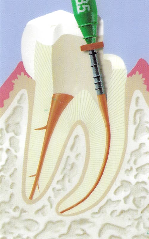 Endodontie-7