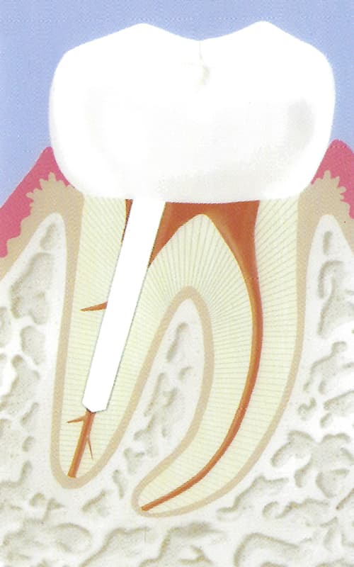 Endodontie-8