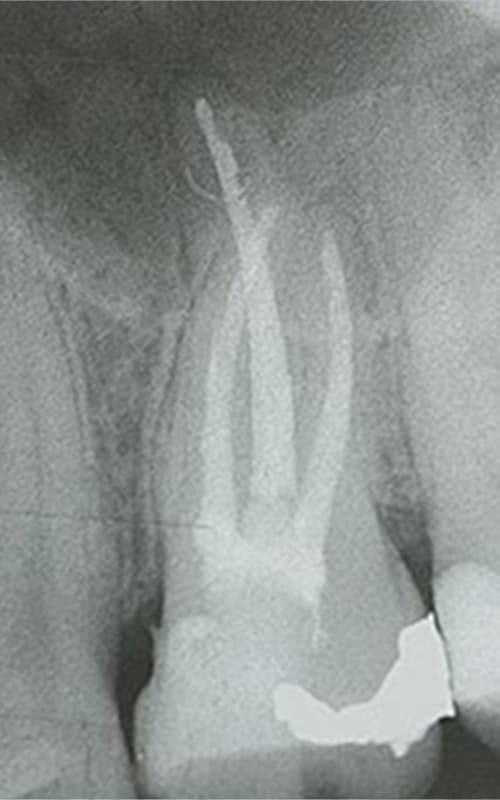 Endodontie-9