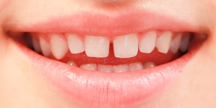 Frontzahnumgesaltung - vorher