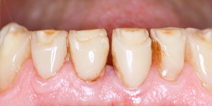 Frontzahnumgesaltung-vorher