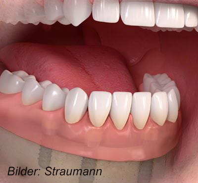 Herausnehmbarer Zahnersatz 1