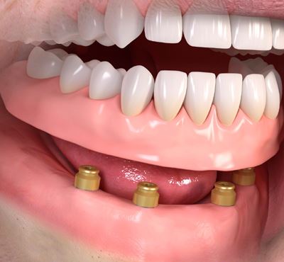 Herausnehmbarer Zahnersatz 2