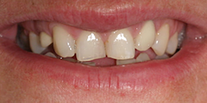 Komposittechnik vorher