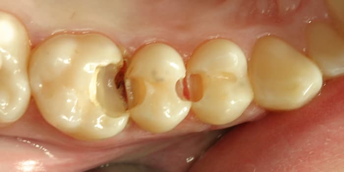 Kompositfüllung Seitenzahn - vorher