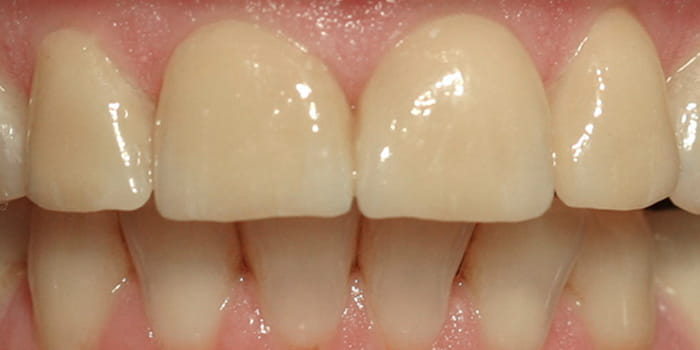 Veneers nachher