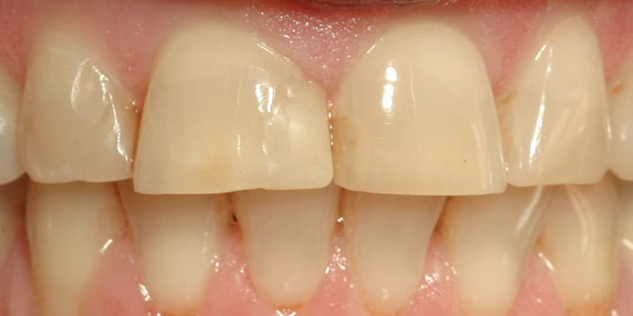 Veneers vorher
