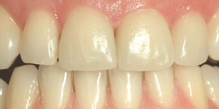 Kronen aus Vollkeramik im Frontzahnbereich - nachher