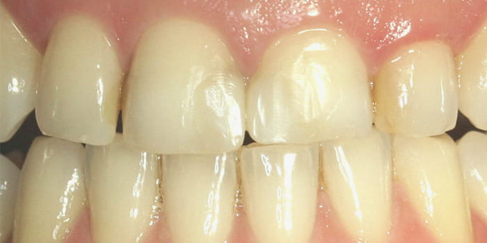 Kronen aus Vollkeramik im Frontzahnbereich - vorher